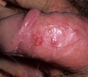 grepes-genitalnii(4).jpg